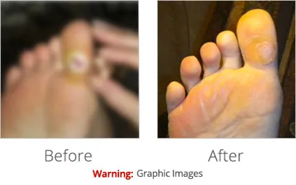 before and after toe